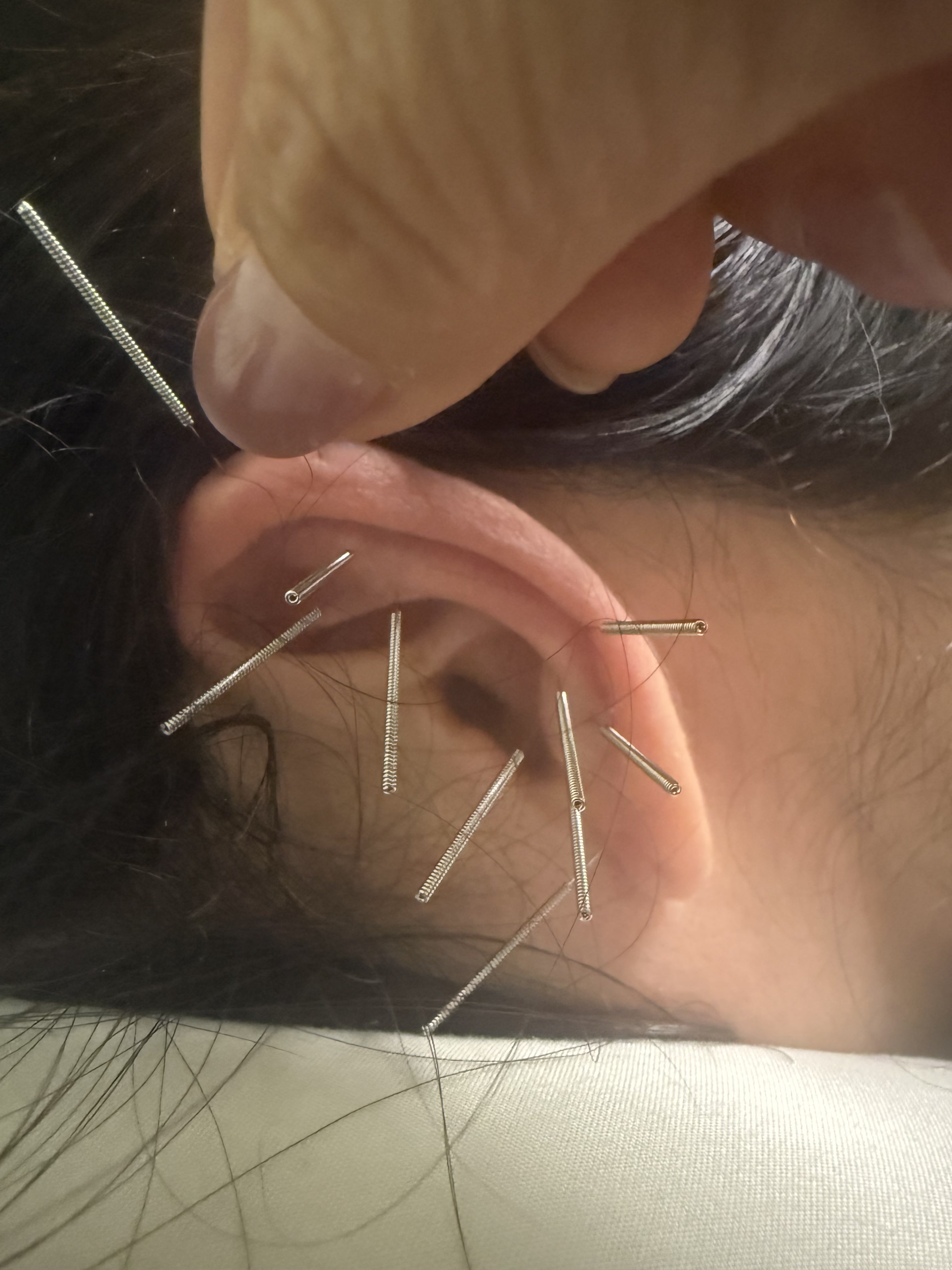 Shizue Hayashi Ito Acupuncture｜カリフォルニア州コスタメサ